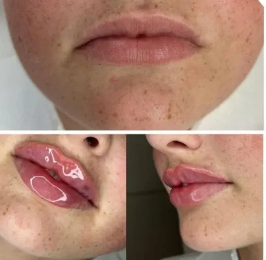 Efekty powiększania ust kwasem hialuronowym